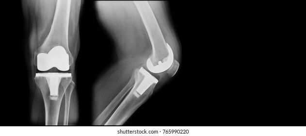 TKR Surgery Treatment TKR Surgery Treatment